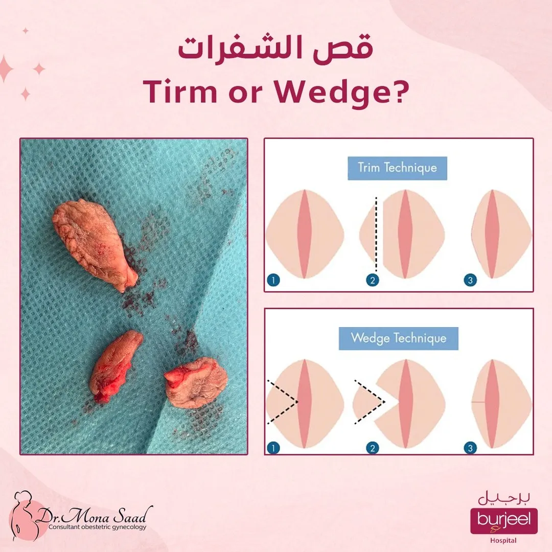 Cosmetic surgery for the inner labia
