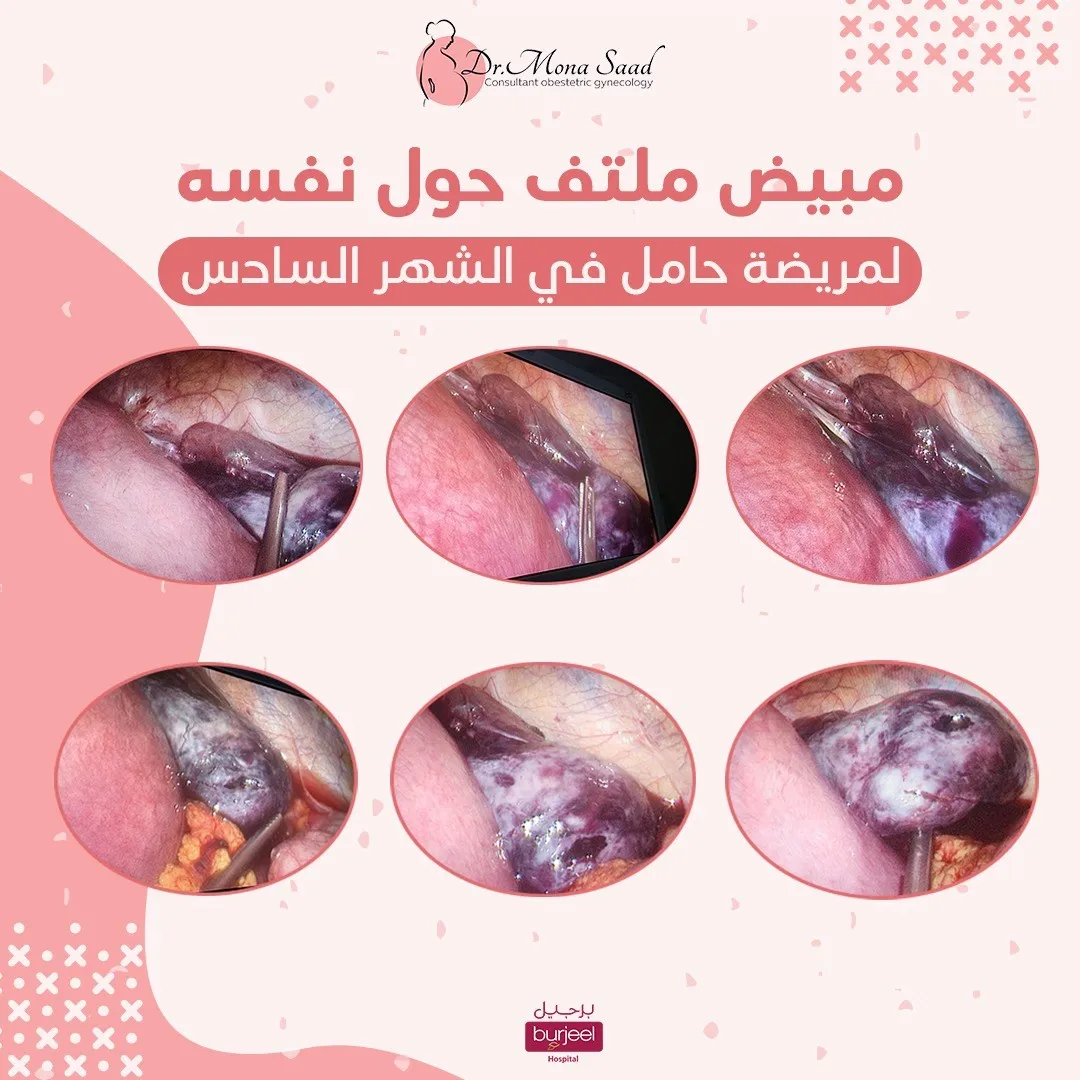 Cases of ovarian twisting