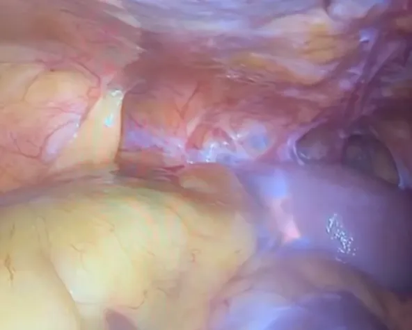 A case of severe adhesions