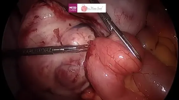 Swelling from the lower abdomen